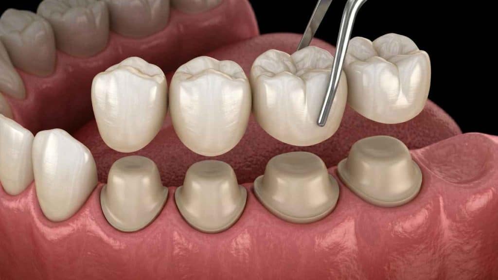 כתרים לשיניים